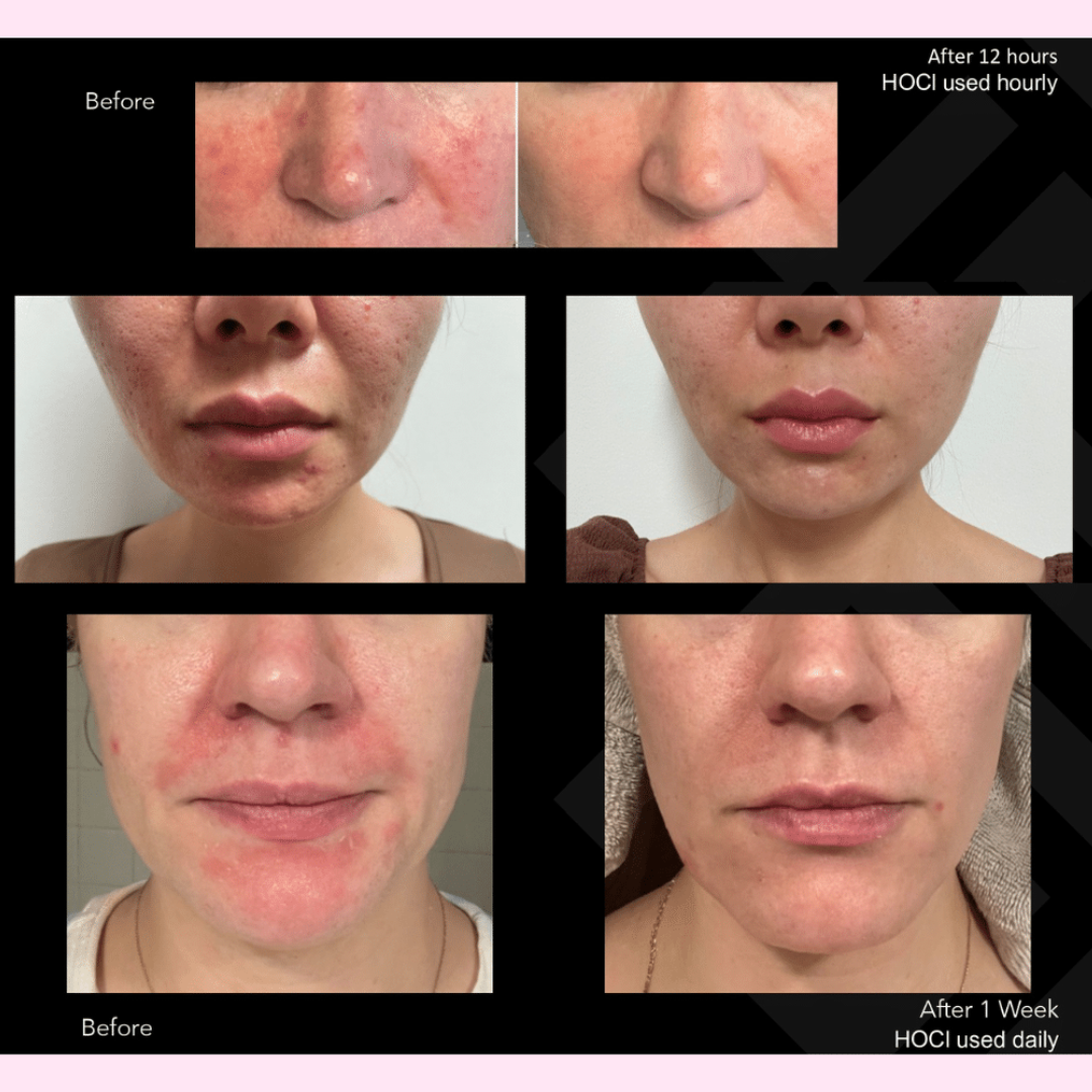 hypochlorous spray by hale derma before and after face pics our favorite Anti Microbial Spray, Antibacterial spray for skin from more than a pretty face